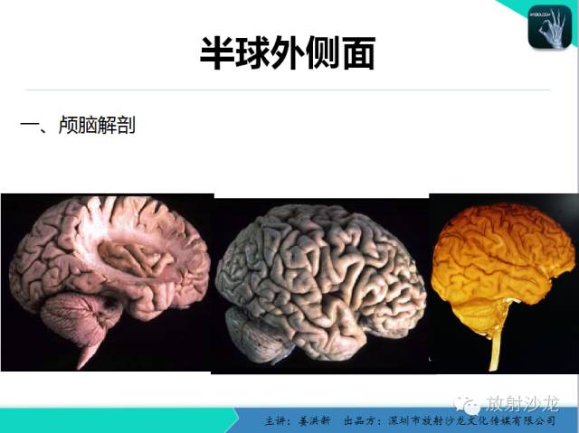 【PPT】高清分辨、精准定位、精准诊断、精准医疗的脑血管疾病应用研究