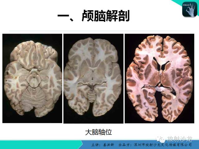 【PPT】高清分辨、精准定位、精准诊断、精准医疗的脑血管疾病应用研究