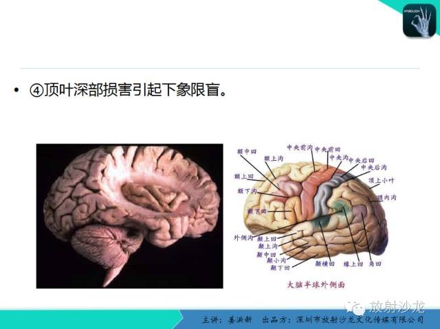 【PPT】高清分辨、精准定位、精准诊断、精准医疗的脑血管疾病应用研究