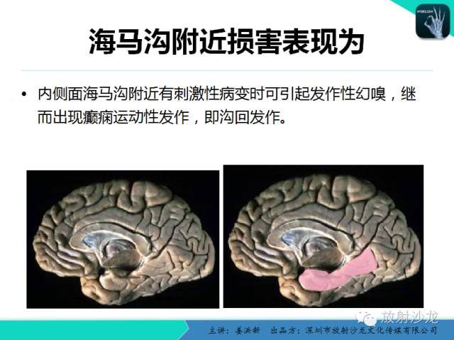 【PPT】高清分辨、精准定位、精准诊断、精准医疗的脑血管疾病应用研究