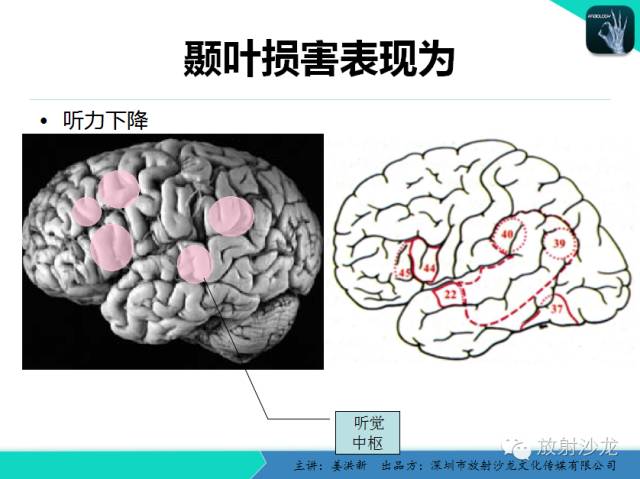 【PPT】高清分辨、精准定位、精准诊断、精准医疗的脑血管疾病应用研究