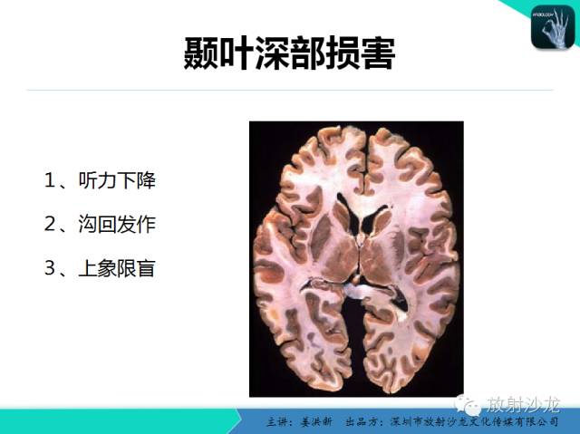 【PPT】高清分辨、精准定位、精准诊断、精准医疗的脑血管疾病应用研究