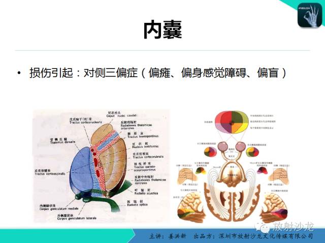 【PPT】高清分辨、精准定位、精准诊断、精准医疗的脑血管疾病应用研究