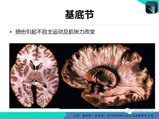 【PPT】高清分辨、精准定位、精准诊断、精准医疗的脑血管疾病应用研究