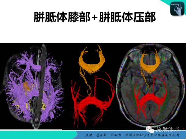 【PPT】高清分辨、精准定位、精准诊断、精准医疗的脑血管疾病应用研究
