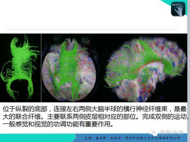 【PPT】高清分辨、精准定位、精准诊断、精准医疗的脑血管疾病应用研究
