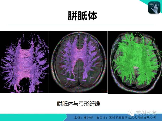 【PPT】高清分辨、精准定位、精准诊断、精准医疗的脑血管疾病应用研究