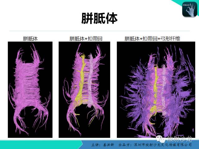 【PPT】高清分辨、精准定位、精准诊断、精准医疗的脑血管疾病应用研究