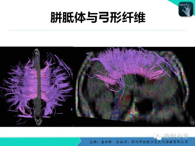 【PPT】高清分辨、精准定位、精准诊断、精准医疗的脑血管疾病应用研究