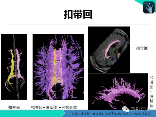 【PPT】高清分辨、精准定位、精准诊断、精准医疗的脑血管疾病应用研究