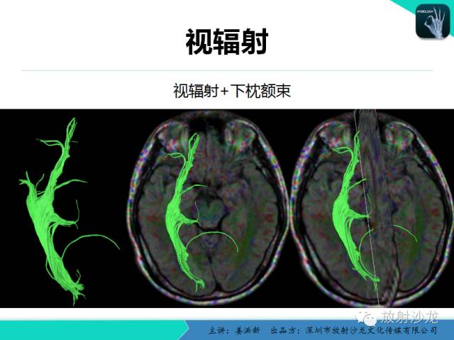 【PPT】高清分辨、精准定位、精准诊断、精准医疗的脑血管疾病应用研究