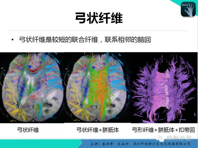 【PPT】高清分辨、精准定位、精准诊断、精准医疗的脑血管疾病应用研究