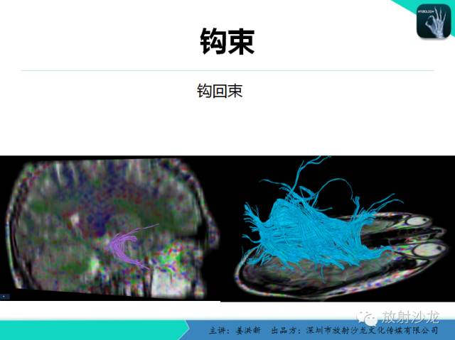 【PPT】高清分辨、精准定位、精准诊断、精准医疗的脑血管疾病应用研究