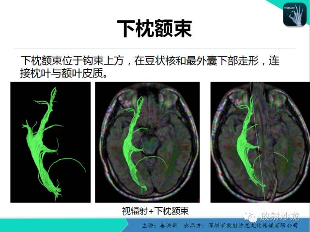 【PPT】高清分辨、精准定位、精准诊断、精准医疗的脑血管疾病应用研究