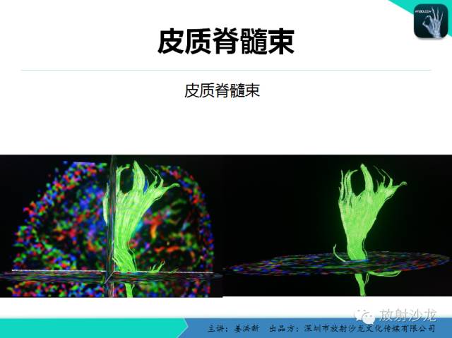 【PPT】高清分辨、精准定位、精准诊断、精准医疗的脑血管疾病应用研究