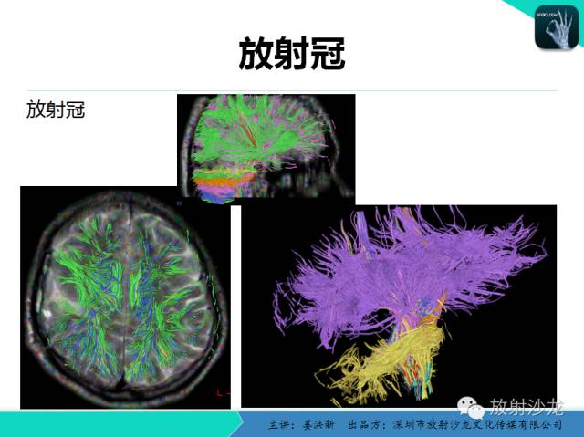 【PPT】高清分辨、精准定位、精准诊断、精准医疗的脑血管疾病应用研究