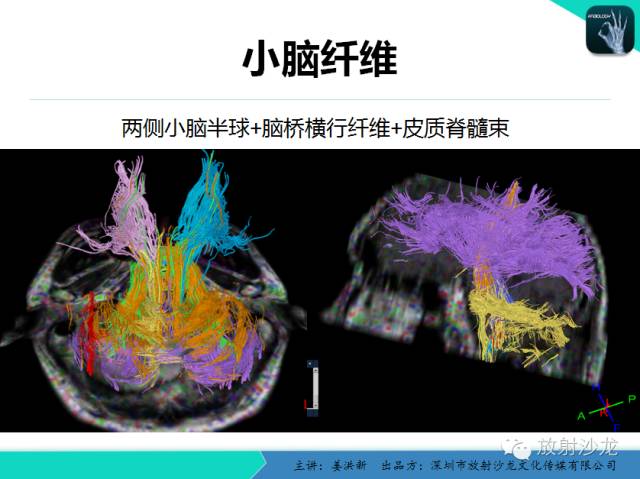 【PPT】高清分辨、精准定位、精准诊断、精准医疗的脑血管疾病应用研究