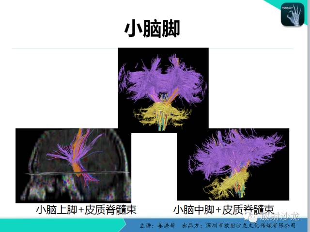 【PPT】高清分辨、精准定位、精准诊断、精准医疗的脑血管疾病应用研究