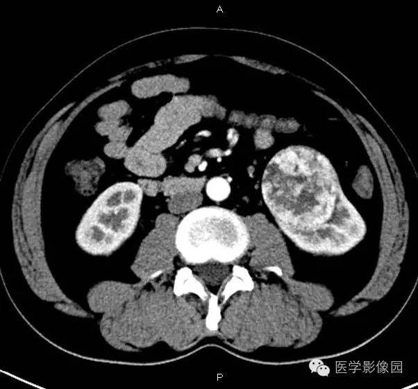 【病例】肾脏透明细胞癌1例CT影像表现 【病例】肾脏透明细胞癌1例CT影像表现