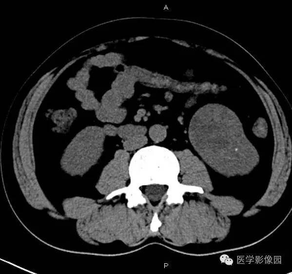 【病例】肾脏透明细胞癌1例CT影像表现 【病例】肾脏透明细胞癌1例CT影像表现