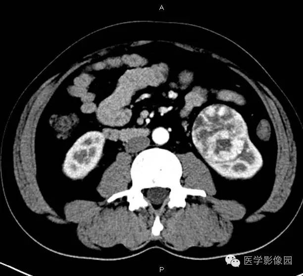 【病例】肾脏透明细胞癌1例CT影像表现 【病例】肾脏透明细胞癌1例CT影像表现