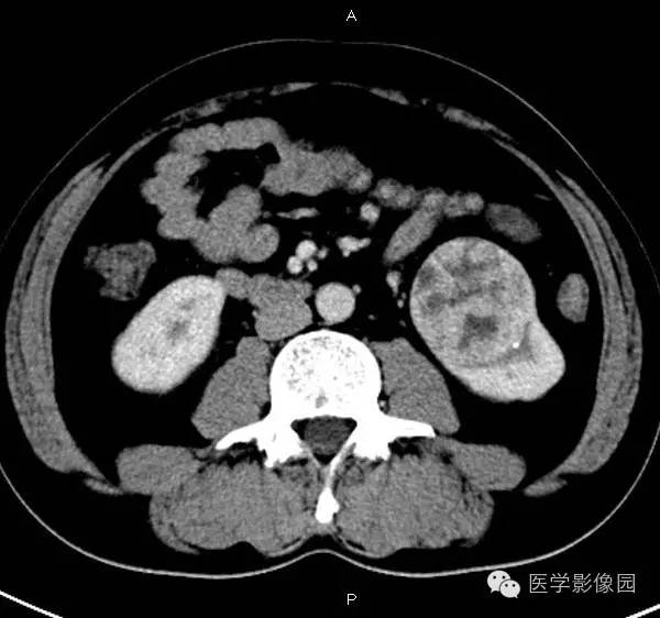 【病例】肾脏透明细胞癌1例CT影像表现 【病例】肾脏透明细胞癌1例CT影像表现