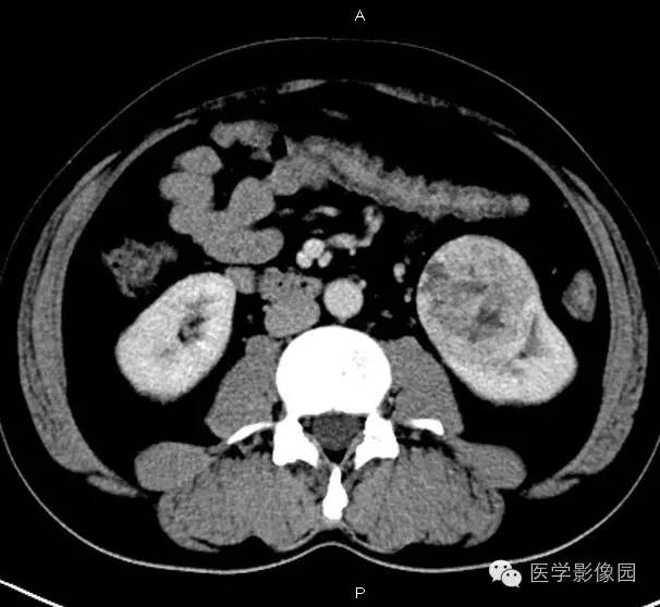 【病例】肾脏透明细胞癌1例CT影像表现 【病例】肾脏透明细胞癌1例CT影像表现