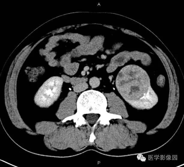 【病例】肾脏透明细胞癌1例CT影像表现 【病例】肾脏透明细胞癌1例CT影像表现