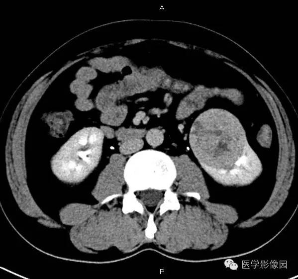 【病例】肾脏透明细胞癌1例CT影像表现 【病例】肾脏透明细胞癌1例CT影像表现