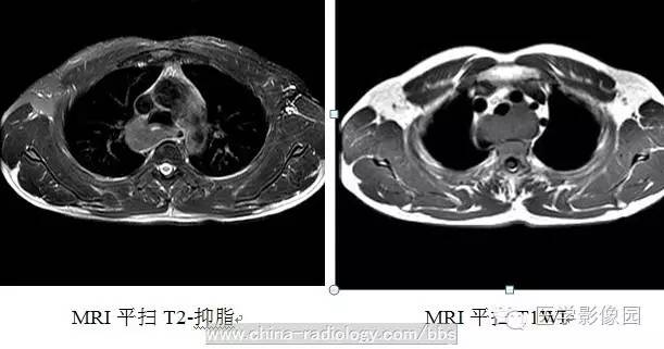 最常见的食管良性肿瘤是什么? ——食管平滑肌瘤 最常见的食管良性肿瘤是什么? ——食管平滑肌瘤