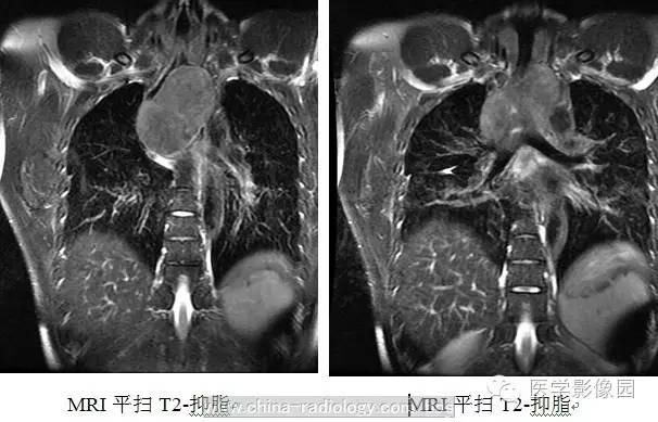 最常见的食管良性肿瘤是什么? ——食管平滑肌瘤 最常见的食管良性肿瘤是什么? ——食管平滑肌瘤