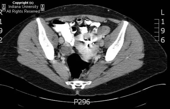 【病例】腹壁子宫内膜异位症1例CT影像表现