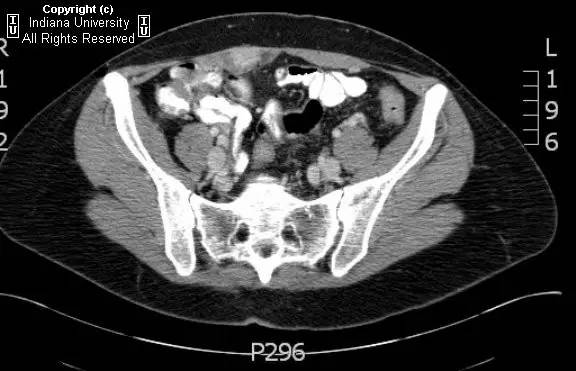 【病例】腹壁子宫内膜异位症1例CT影像表现
