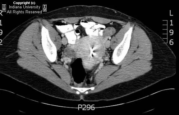 【病例】腹壁子宫内膜异位症1例CT影像表现