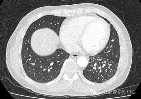 【病例】异常体动脉供血左肺下叶1例CT影像表现 【病例】异常体动脉供血左肺下叶1例CT影像表现
