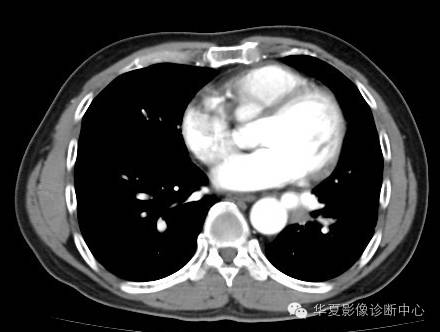 【病例】异常体动脉供血左肺下叶1例CT影像表现 【病例】异常体动脉供血左肺下叶1例CT影像表现