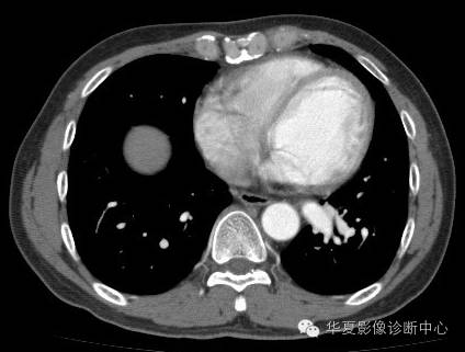 【病例】异常体动脉供血左肺下叶1例CT影像表现 【病例】异常体动脉供血左肺下叶1例CT影像表现