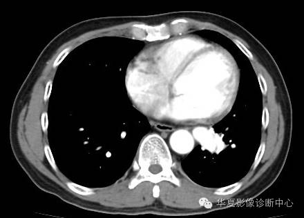 【病例】异常体动脉供血左肺下叶1例CT影像表现 【病例】异常体动脉供血左肺下叶1例CT影像表现