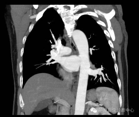 【病例】异常体动脉供血左肺下叶1例CT影像表现 【病例】异常体动脉供血左肺下叶1例CT影像表现