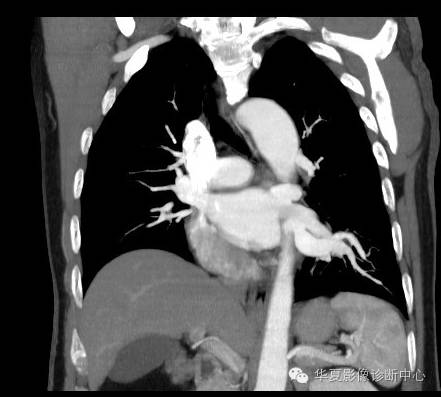 【病例】异常体动脉供血左肺下叶1例CT影像表现 【病例】异常体动脉供血左肺下叶1例CT影像表现