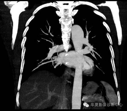 【病例】异常体动脉供血左肺下叶1例CT影像表现 【病例】异常体动脉供血左肺下叶1例CT影像表现