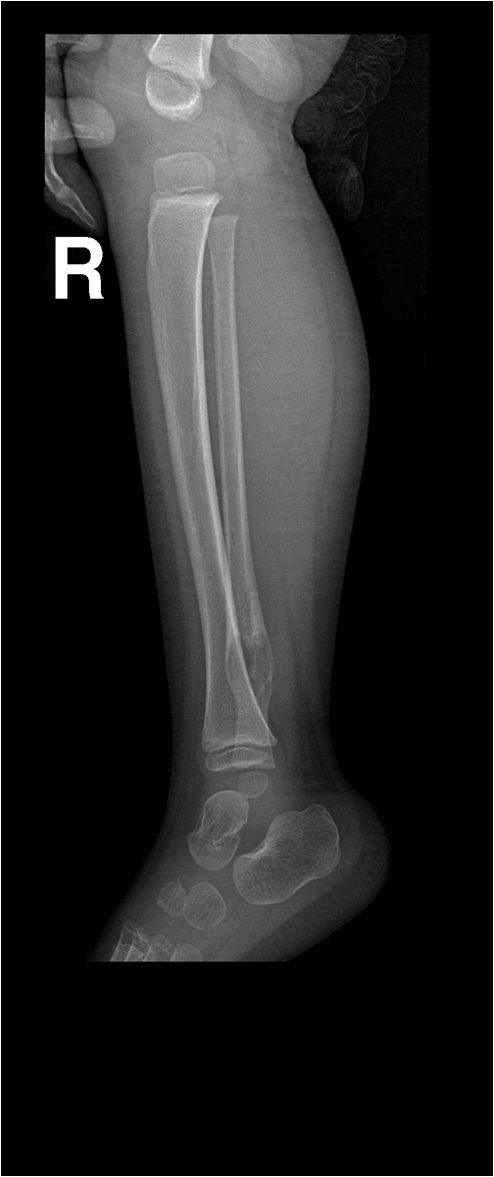 【病例】右腓骨下段骨纤维结构不良 【病例】右腓骨下段骨纤维结构不良