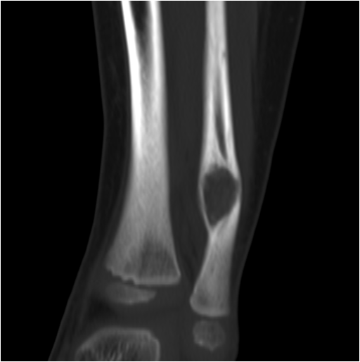 【病例】右腓骨下段骨纤维结构不良 【病例】右腓骨下段骨纤维结构不良