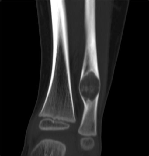 【病例】右腓骨下段骨纤维结构不良 【病例】右腓骨下段骨纤维结构不良