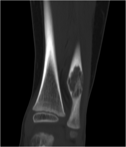 【病例】右腓骨下段骨纤维结构不良 【病例】右腓骨下段骨纤维结构不良