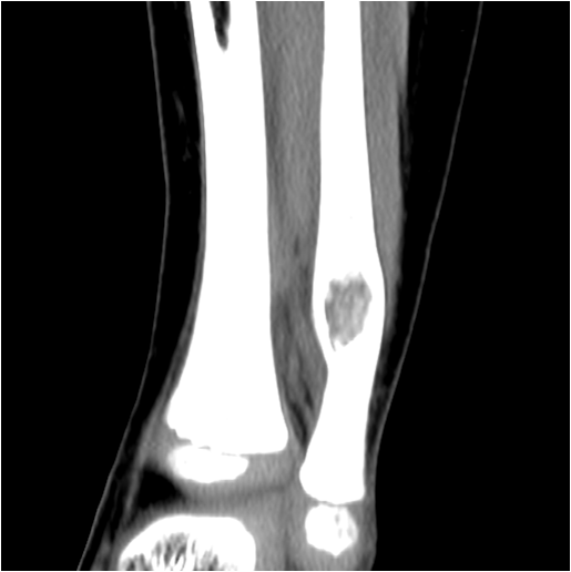 【病例】右腓骨下段骨纤维结构不良 【病例】右腓骨下段骨纤维结构不良