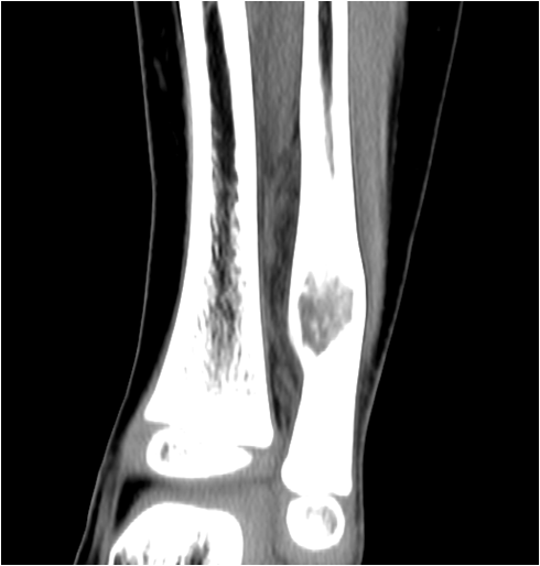 【病例】右腓骨下段骨纤维结构不良 【病例】右腓骨下段骨纤维结构不良