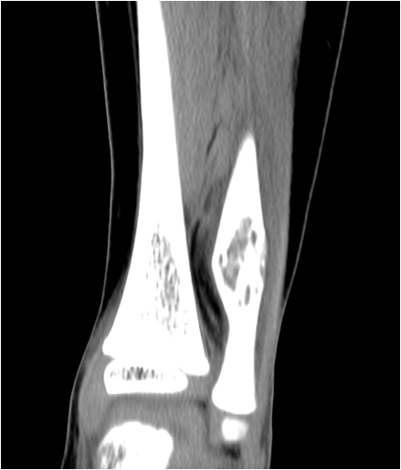 【病例】右腓骨下段骨纤维结构不良 【病例】右腓骨下段骨纤维结构不良