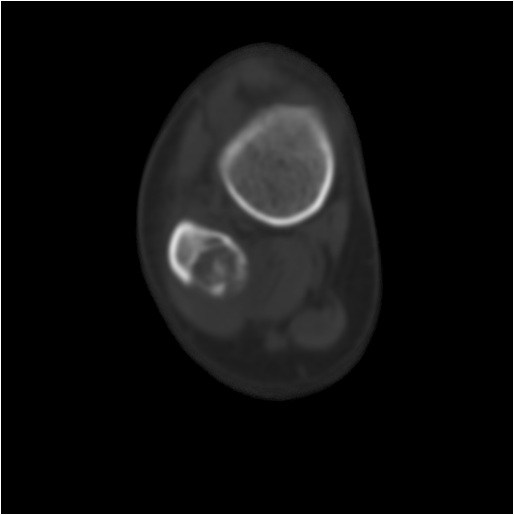 【病例】右腓骨下段骨纤维结构不良 【病例】右腓骨下段骨纤维结构不良