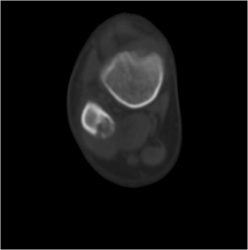 【病例】右腓骨下段骨纤维结构不良 【病例】右腓骨下段骨纤维结构不良